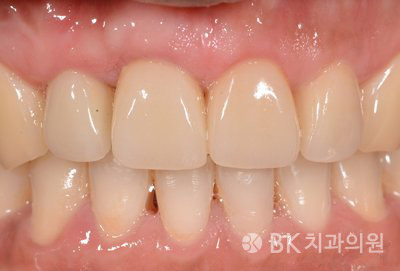 타치과에서 발치 권유 10년째 심미적으로 사용중(클릭하시면 전후 엑스레이를 볼수 있습니다)