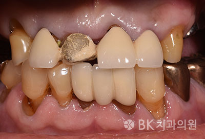 전악보철(클릭하시면 전후 엑스레이를 볼수 있습니다)
