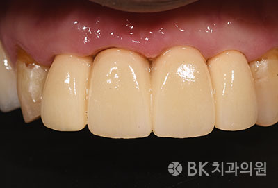 발치즉시 임플란트